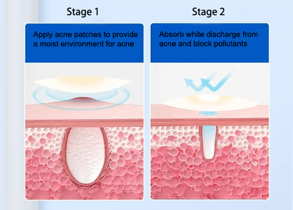 Hydrocolloid Acne Patch